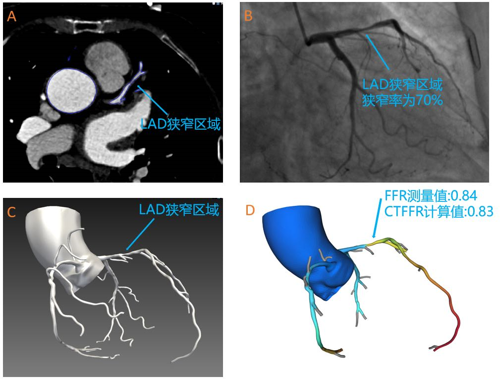 奧泰康助力睿心醫(yī)療—《冠狀動脈供血功能（CT-FFR）評估軟件》產(chǎn)品完成創(chuàng)新審評及臨床試驗(yàn)